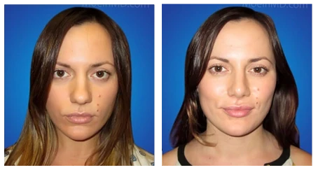 Before-and-after images of a woman's face showcasing the transformative effects of rhinoplasty.