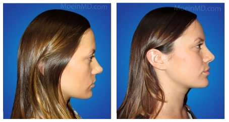 Rhinoplasty transformation.