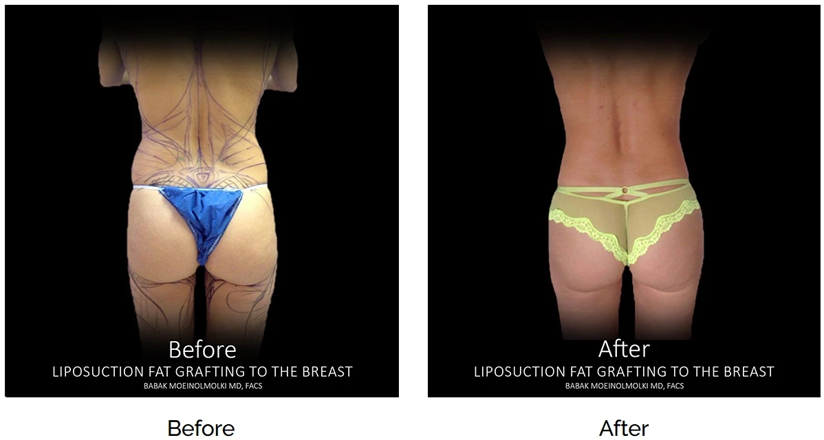 Tummy tuck with liposuction before and after.