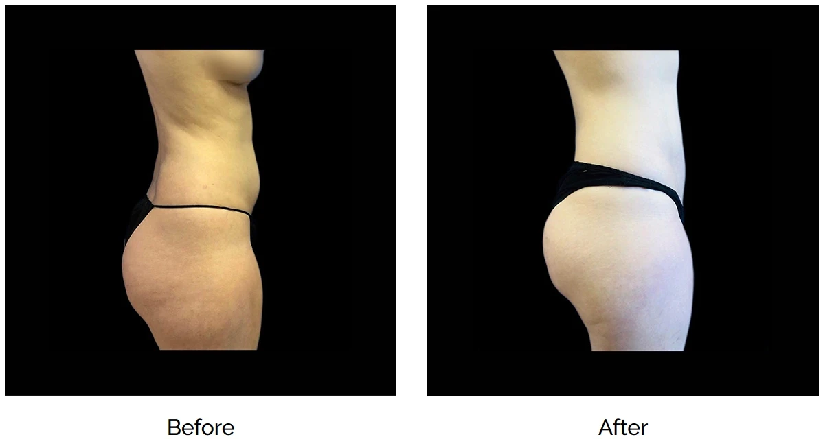 Tummy tuck and liposuction before and after.