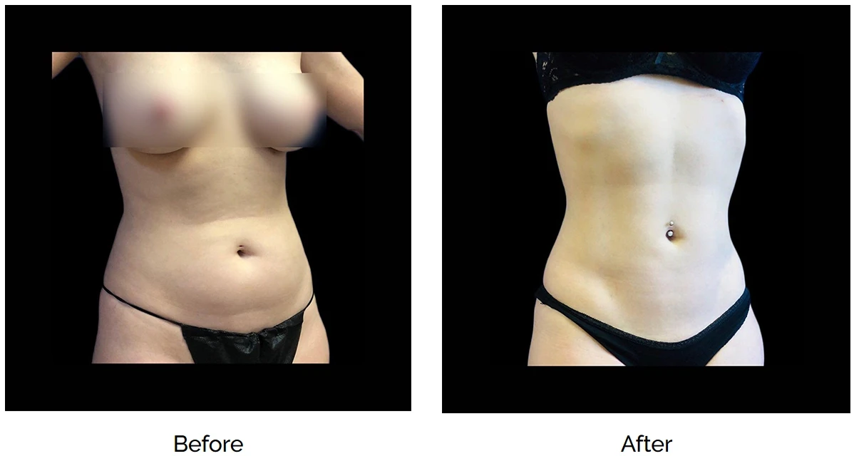 Tummy tuck before and after with liposuction.