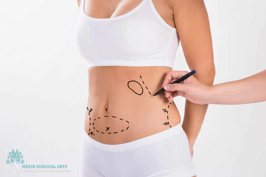 Benefits of Lipo Procedure