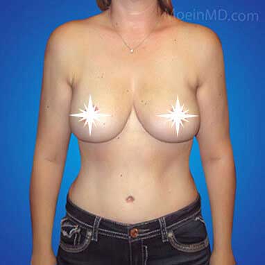 A woman's breast before and after breast reduction surgery.