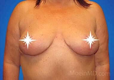 A woman's breast before and after breast reduction.