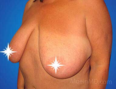 A woman's breast before and after breast reduction.