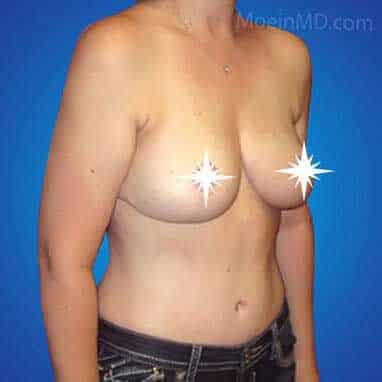 Before and After Breast Augmentation.