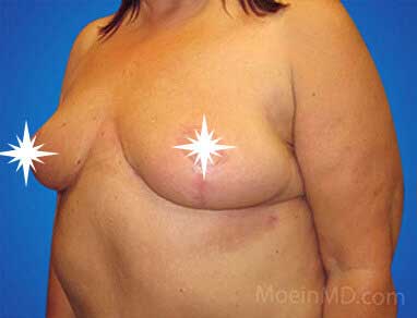 A woman's breast before and after breast reduction.