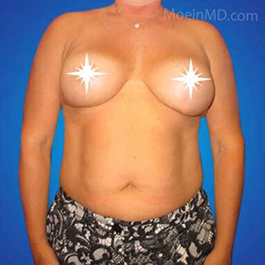 A woman's breast before and after breast reduction.