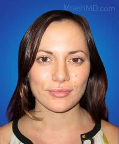 Before and after dermal fillers, a woman's face transformed through rhinoplasty.