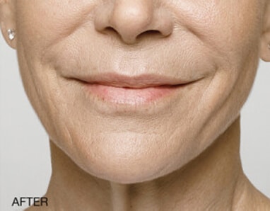 A woman's face before and after dermal fillers.