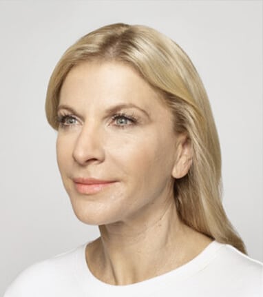 A woman with dermal fillers before and after, wearing a white t-shirt.