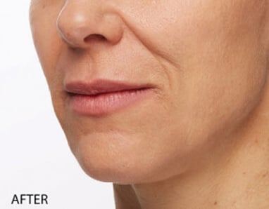 A woman's face before and after dermal fillers.