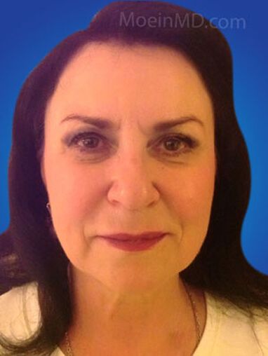 A woman's transformation, showcasing dermal fillers before and after, against a blue background.