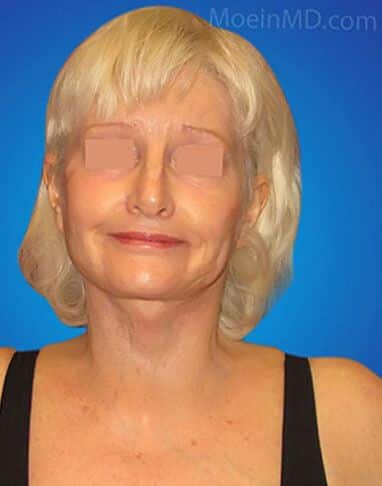 A woman's neck before and after a facelift.