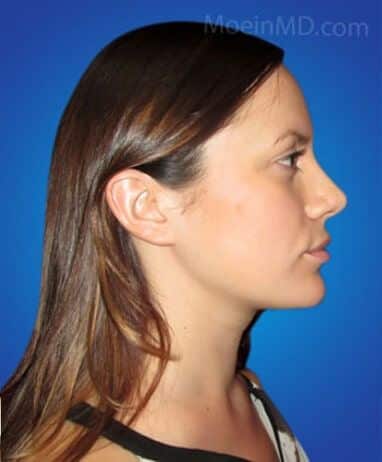 A woman's profile before and after a rhinoplasty.