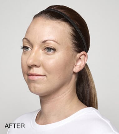 A woman's face before and after dermal fillers.