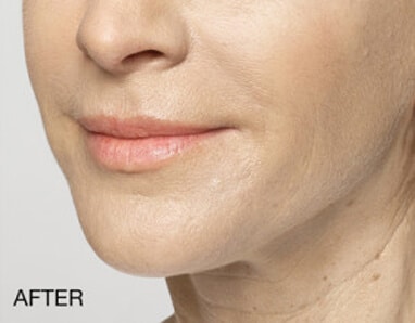 A woman's face before and after DERMAL FILLERS.