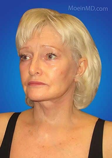 A woman with white hair showcasing a stunning face lift transformation against a blue background.