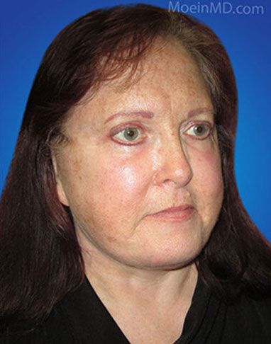 A woman's face before a facelift, displaying the dramatic transformation after the procedure.