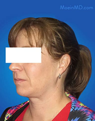 A woman's neck before and after a facelift.