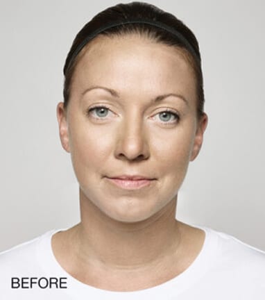 Before and after dermal fillers, a woman's face is transformed through a facelift.