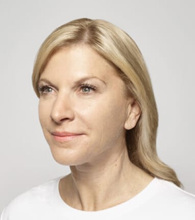 A woman showing dermal fillers results wearing a white t-shirt.