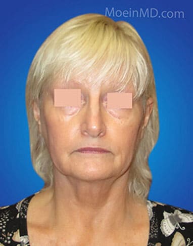 A woman's face before and after rhinoplasty, including a neck lift.