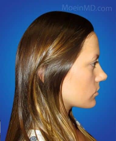 A woman's profile transformation before and after rhinoplasty, with the use of dermal fillers.