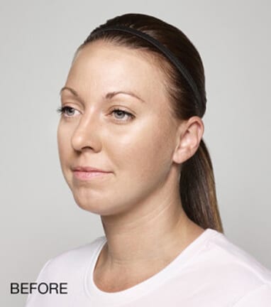 A woman's face showing the transformative results of dermal fillers before and after.