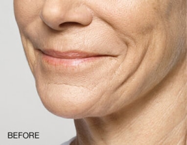 A woman's face transformed with dermal fillers before and after a facelift.