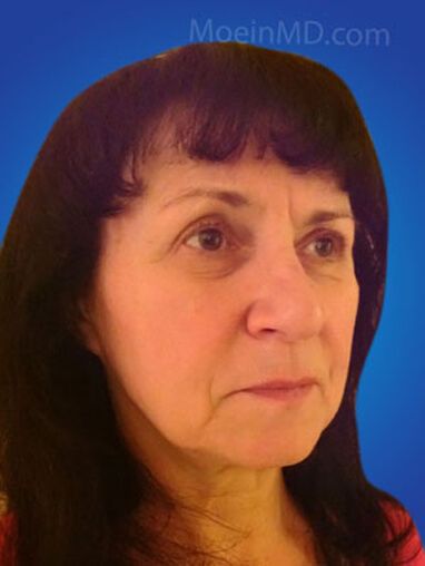 A woman with dark hair showcasing her dermal fillers before and after against a blue background.