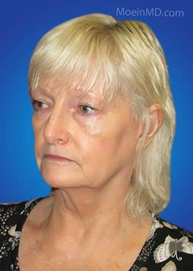 A woman with blond hair showcasing a stunning face lift transformation against a blue background.