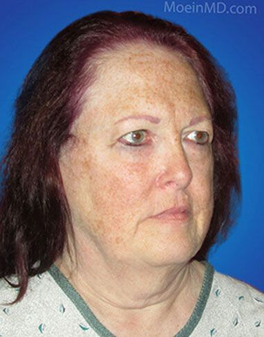 A woman's face before undergoing a facelift, showing the transformation before and after the procedure.