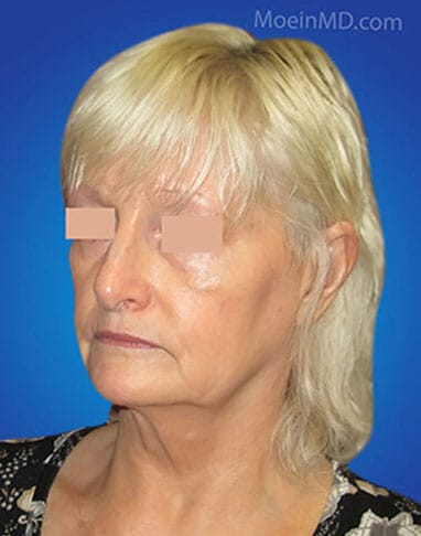 A woman's face after a rhinoplasty, featuring a neck lift.