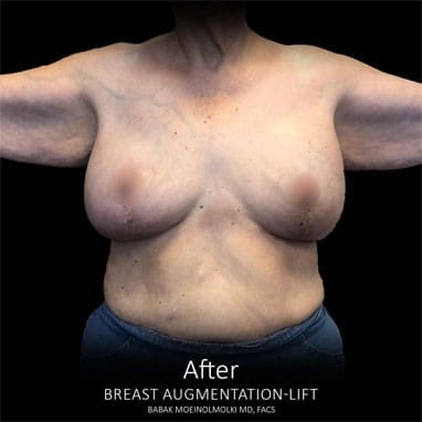 A woman's breast before and after a breast augmentation lift.