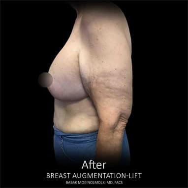 Breast augmentation lift with before-and-after comparison.