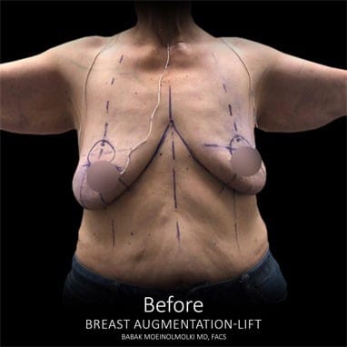 Breast lift with before and after results.