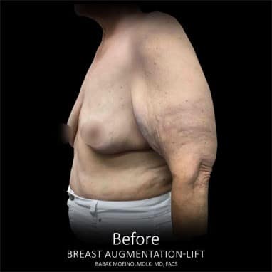 Before and after breast lift.