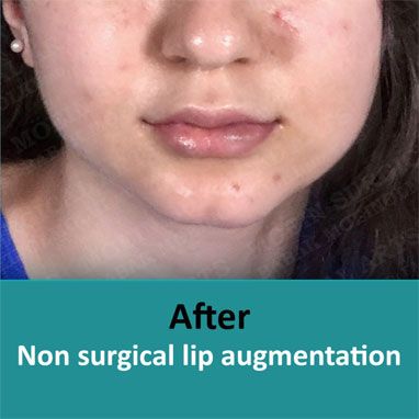 lip augmentation before and after