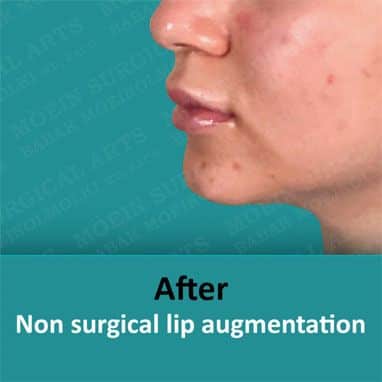 Non surgical lip augmentation using dermal fillers.