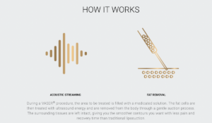 What is VASER Lipo | Moein Surgical Arts