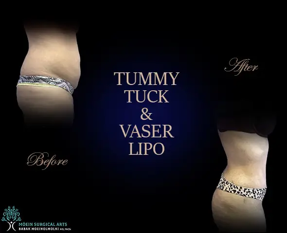 Vaser liposuction with tummy tuck.