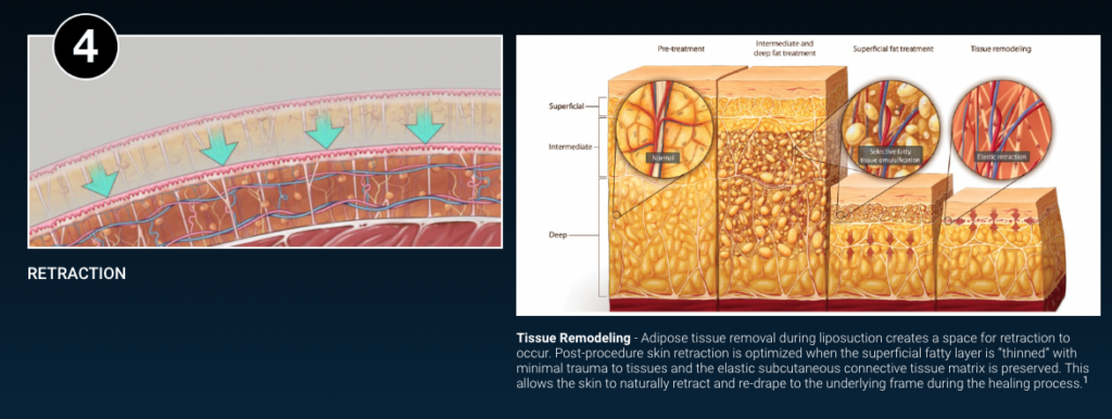 VASER skin retraction