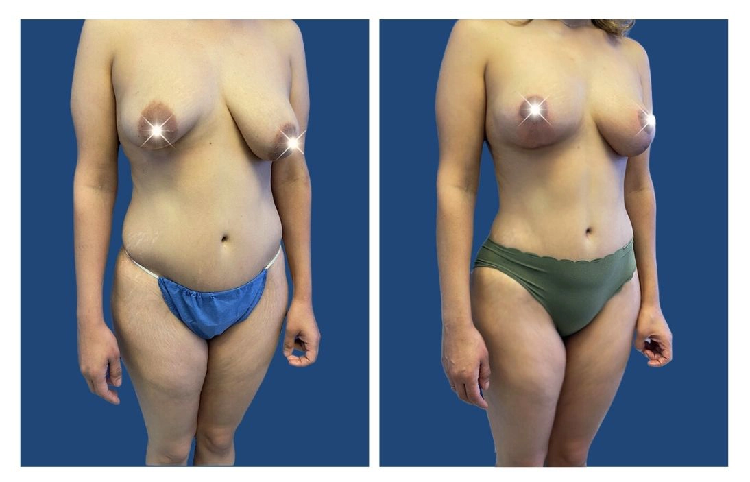 BEFORE AND AFTER BREAST AUGMENTATION AND LIFT