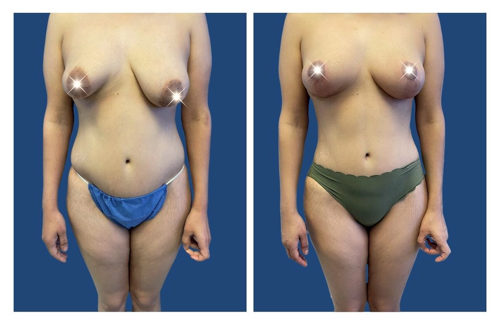 BREAST AUGMENTATION AND LIFT BEFOE AND AFTER