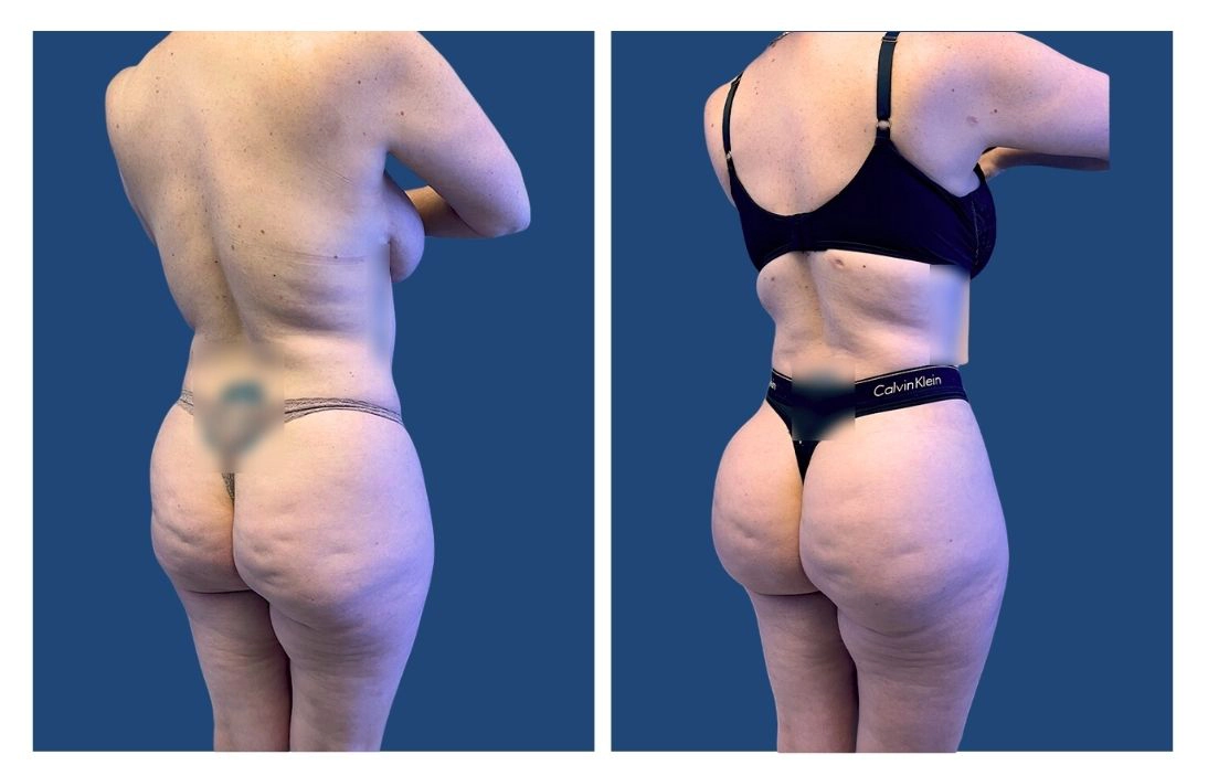 Before and After Liposuction