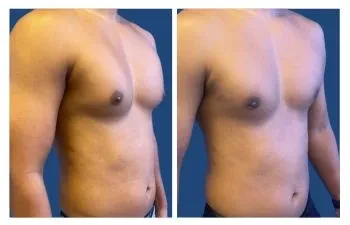 Gyno Before and After