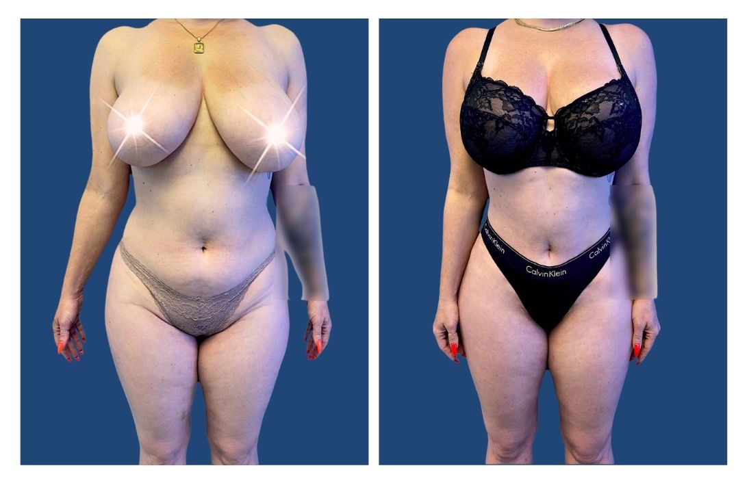 Liposuction Before and After