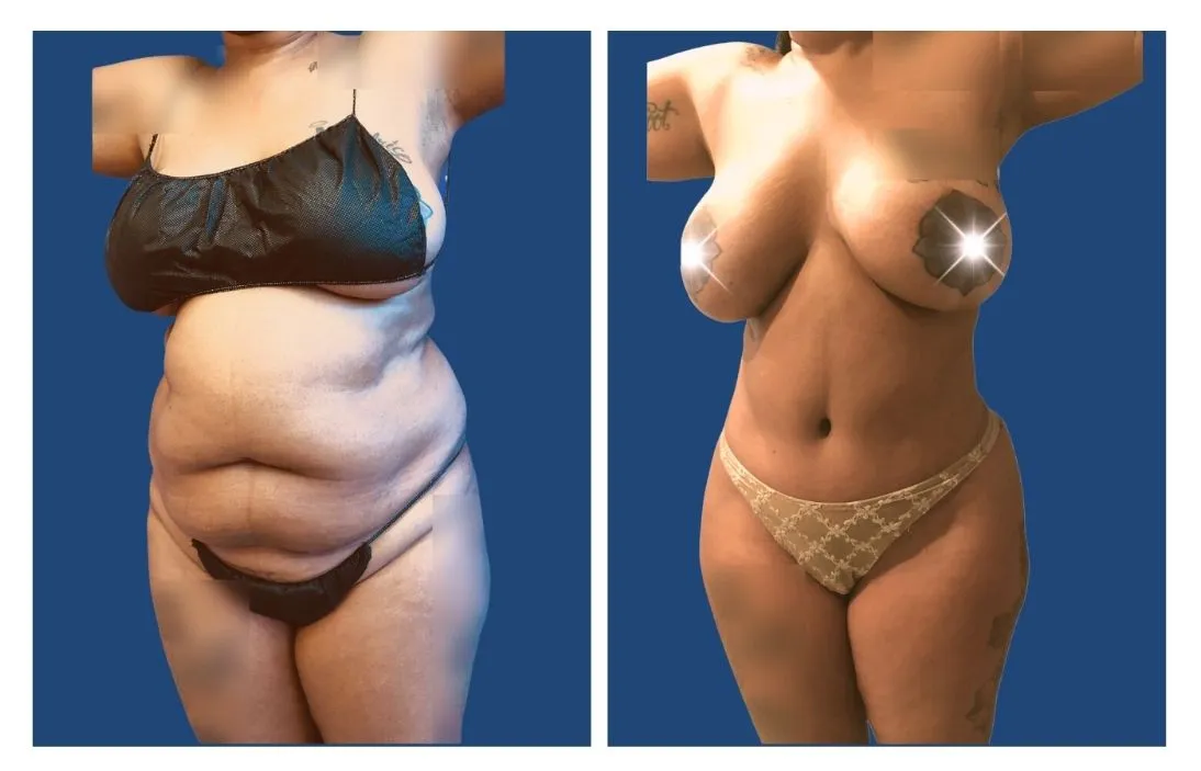 Liposuction Before and After- Los Angeles