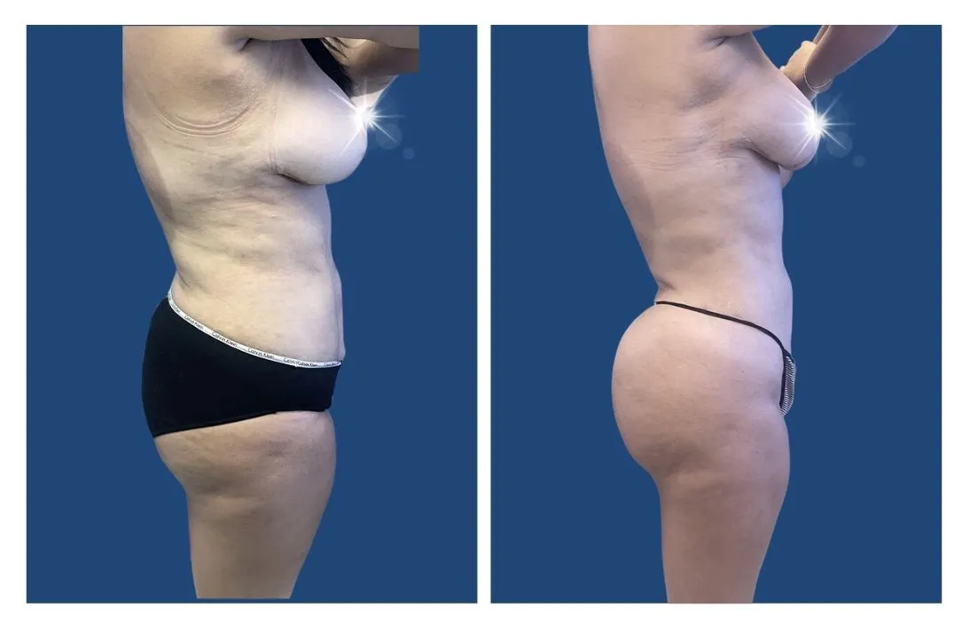 Liposuction Surgery Los Angeles, CA